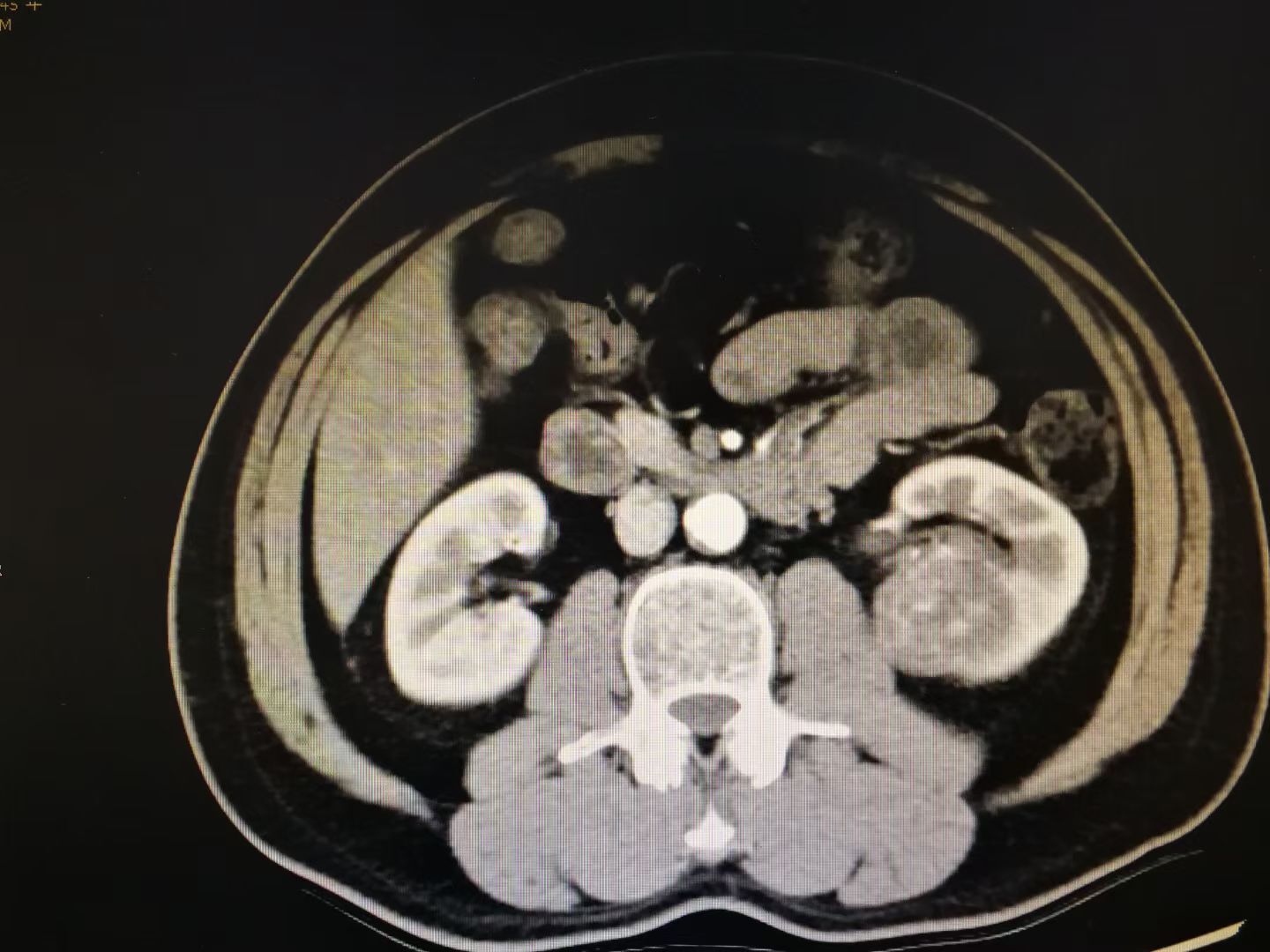 肾脏占位是怎么回事肾癌肾盂癌错构瘤肾囊肿黄色肉芽肿性肾盂肾炎