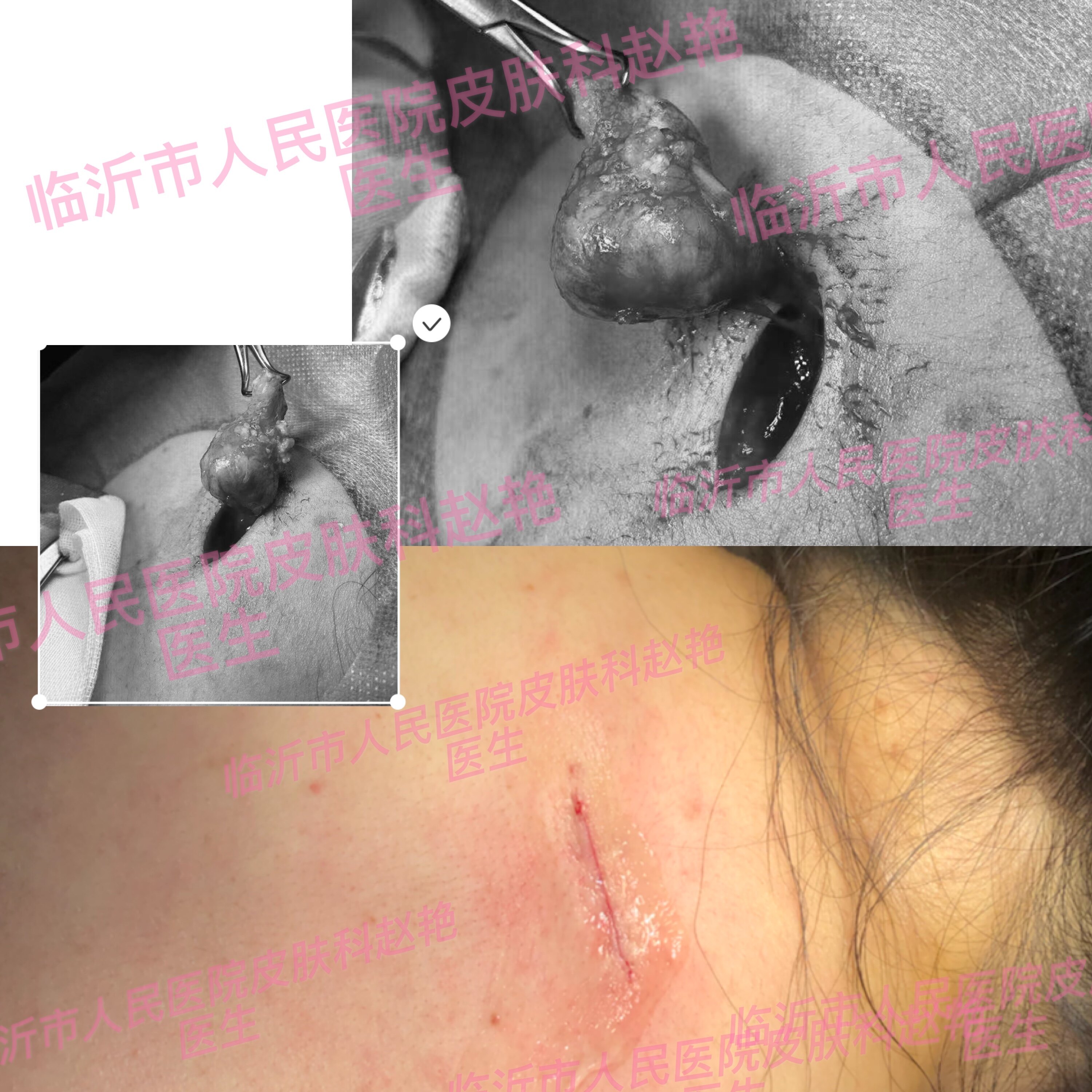 皮脂腺囊肿!尽早切除