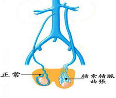 治疗精索静脉曲张的新利器介入栓塞术