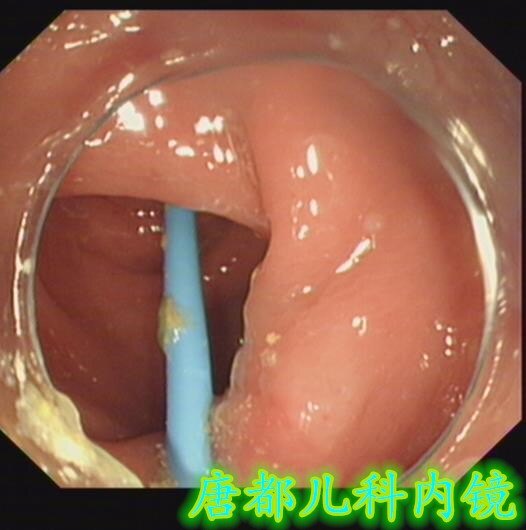 小儿阑尾炎内镜诊疗病例-20210510