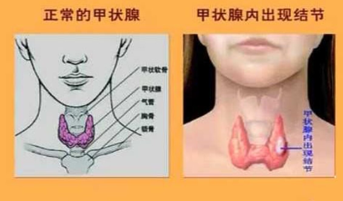 甲状腺癌的临床表现