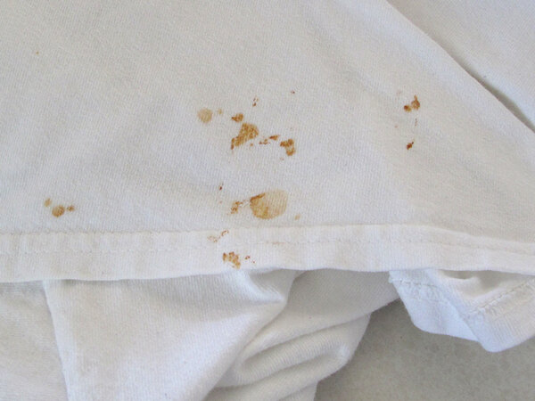 破解衣服上的"血案",乳头出血就是乳腺癌吗
