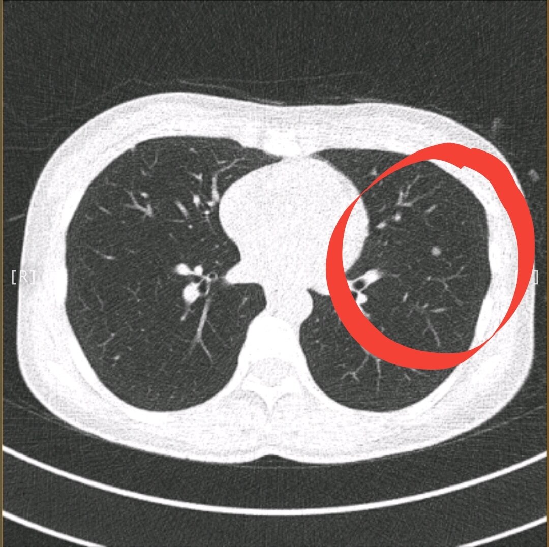 刘懿博士说肺癌二三亖二爸是肺癌走的35岁5mm结节也是肺癌
