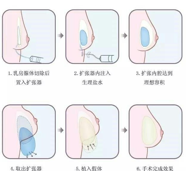 乳腺癌一期假体再造术后注意事项_乳房重建术 - 好
