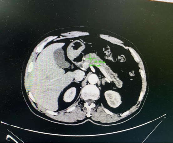 【病例分享】胰腺癌晚期治疗"奇迹"发生,出院后感谢医生救命之恩!