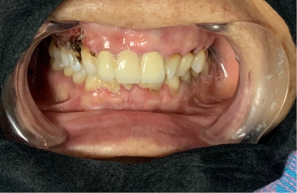 肿瘤患者牙龈尖锐湿疣激光光动力治疗一例