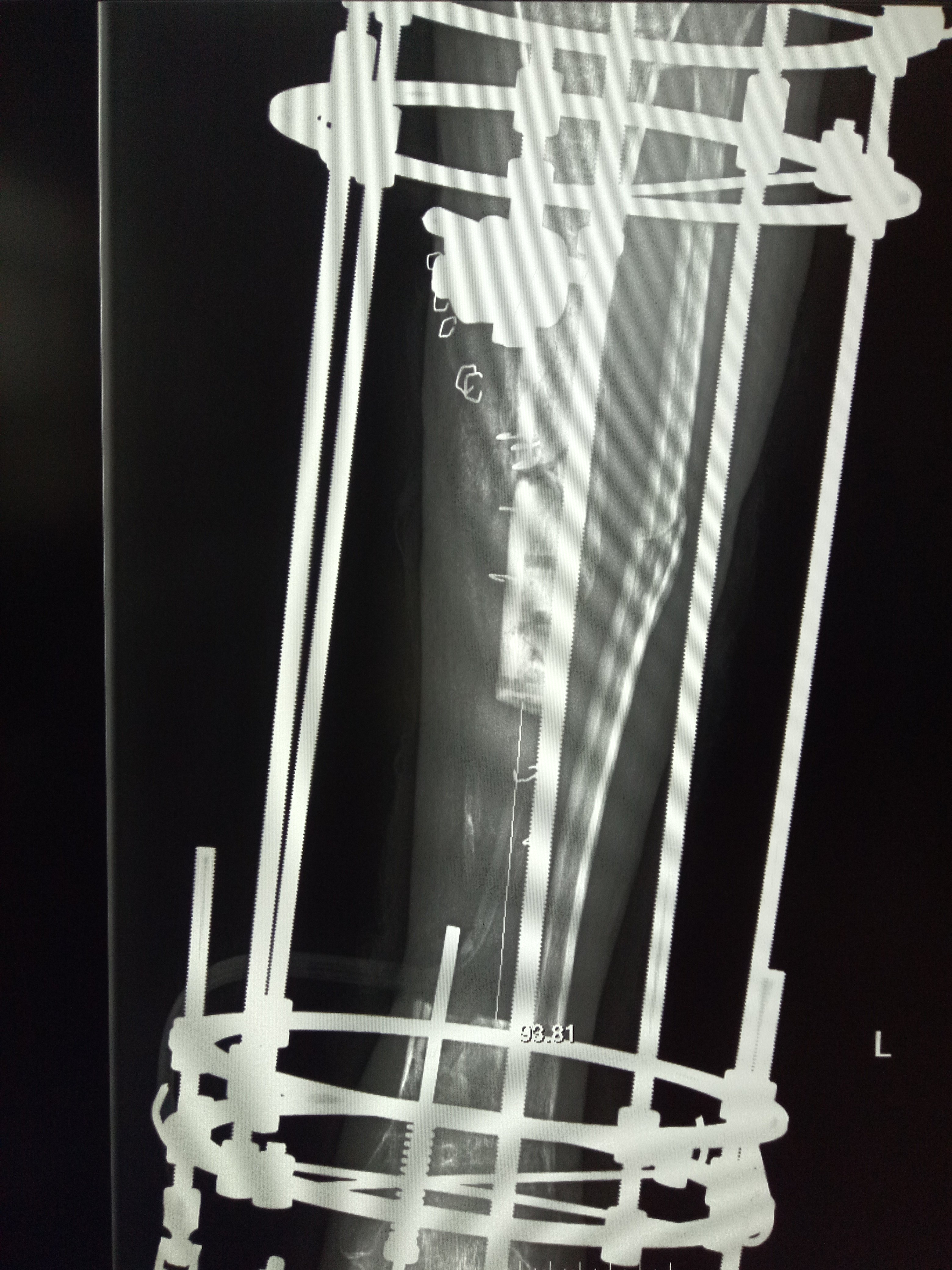 骨延长(骨运输)的定义及手术适应症 - 好大夫在