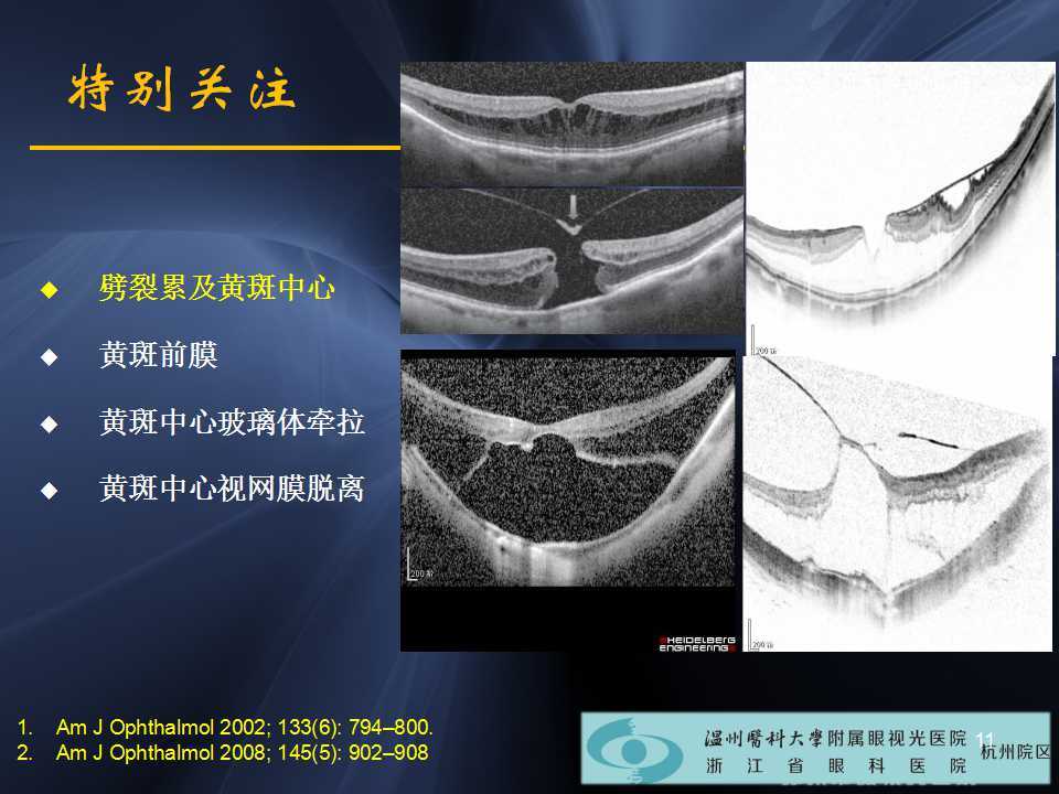 高度近视黄斑劈裂