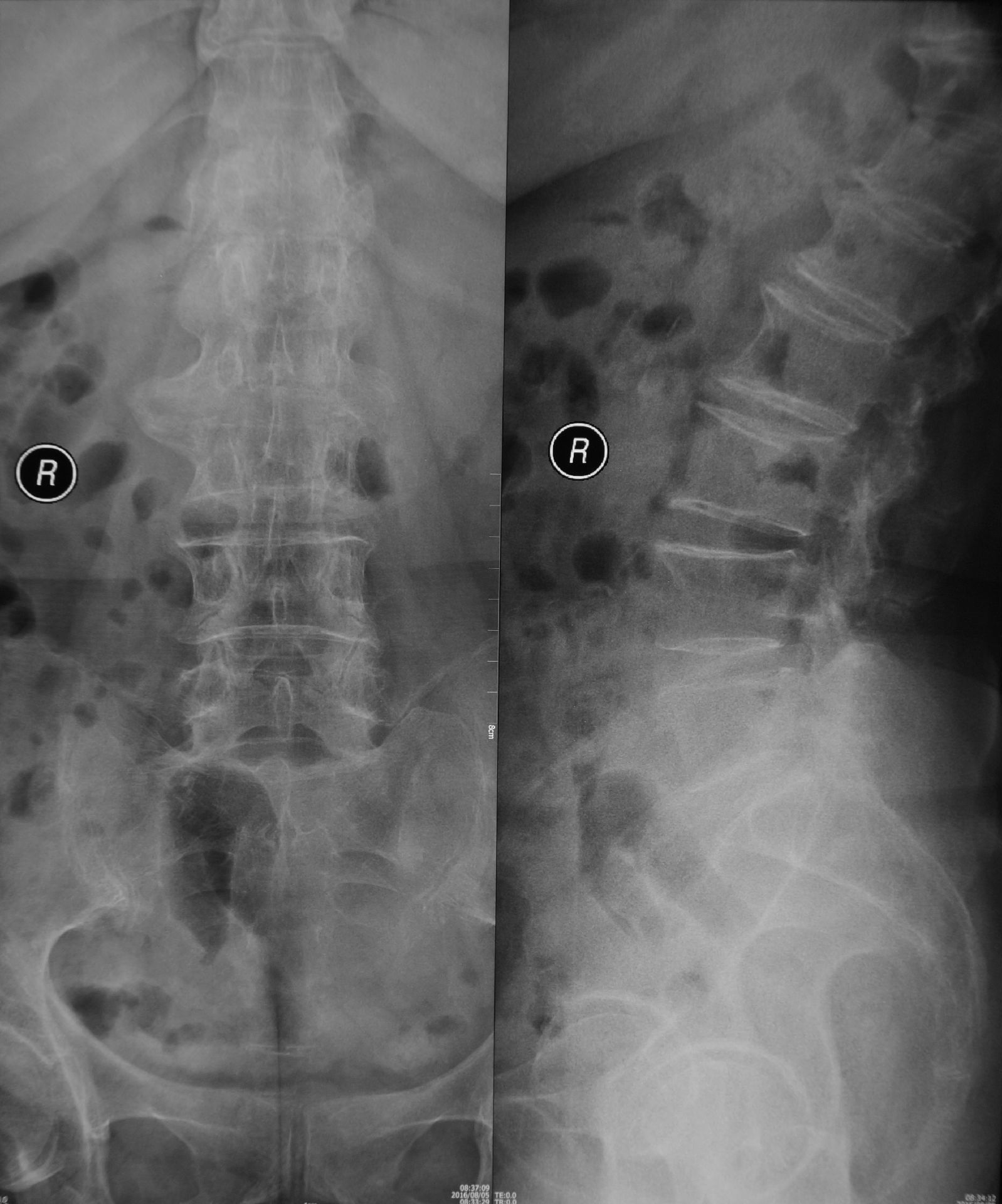        术前正侧位x线片显示腰椎