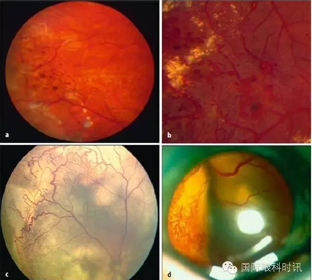 d coats病晚期可见固态脂质渗出和全 视网膜脱离 .