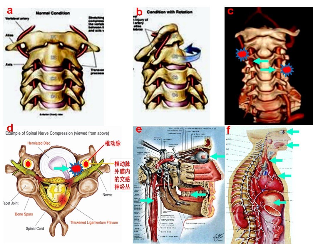 颈椎不稳定会刺激颈椎横突孔内的椎动脉和椎动脉外膜内的交感神经