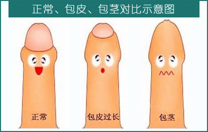 包皮过长,包茎的危害及手术指征