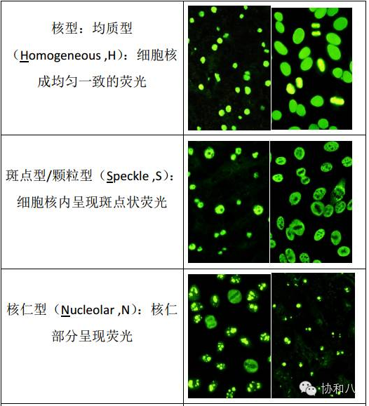 核型>>>>有意义1:160~1:320;最高:1:1280 (后面数值越高,表明滴度越大