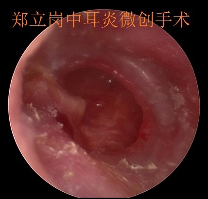 慢性中耳乳突炎感染期耳内镜微创手术第343广