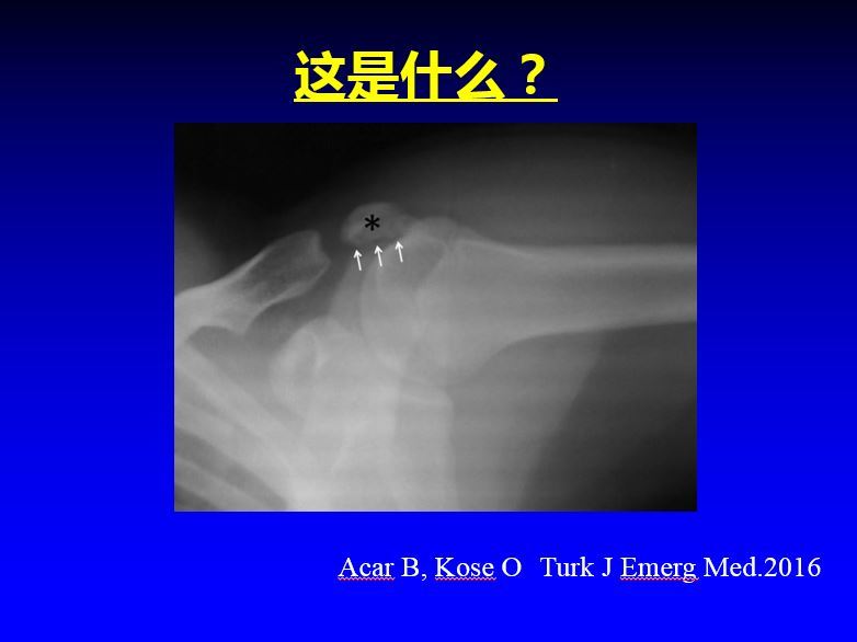 从自行车上摔下来肩关节疼痛:是肩峰骨折还是肩峰小骨