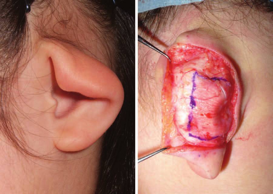 从耳周肌肉分布图解释杯状耳,招风耳,隐耳畸形如何修复_耳部整形_手术