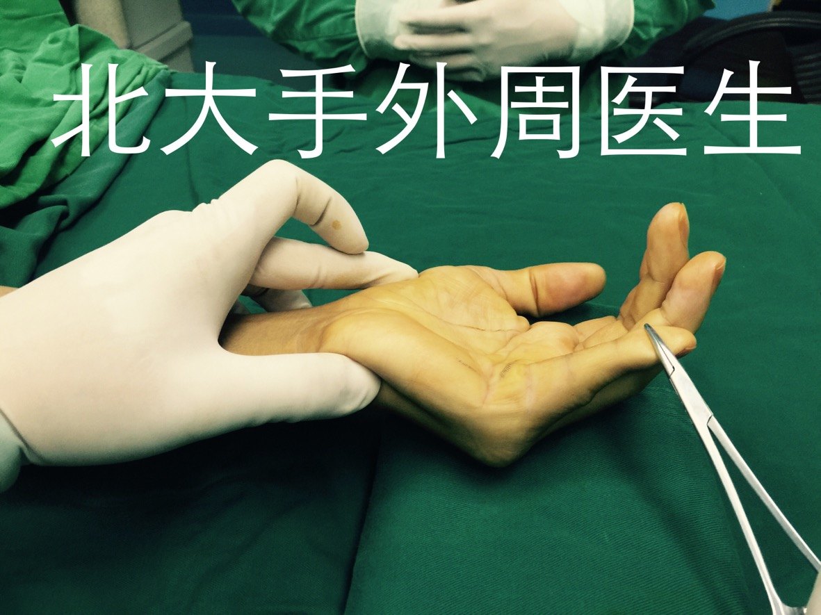 手指屈曲挛缩的原因之一掌腱膜挛缩症