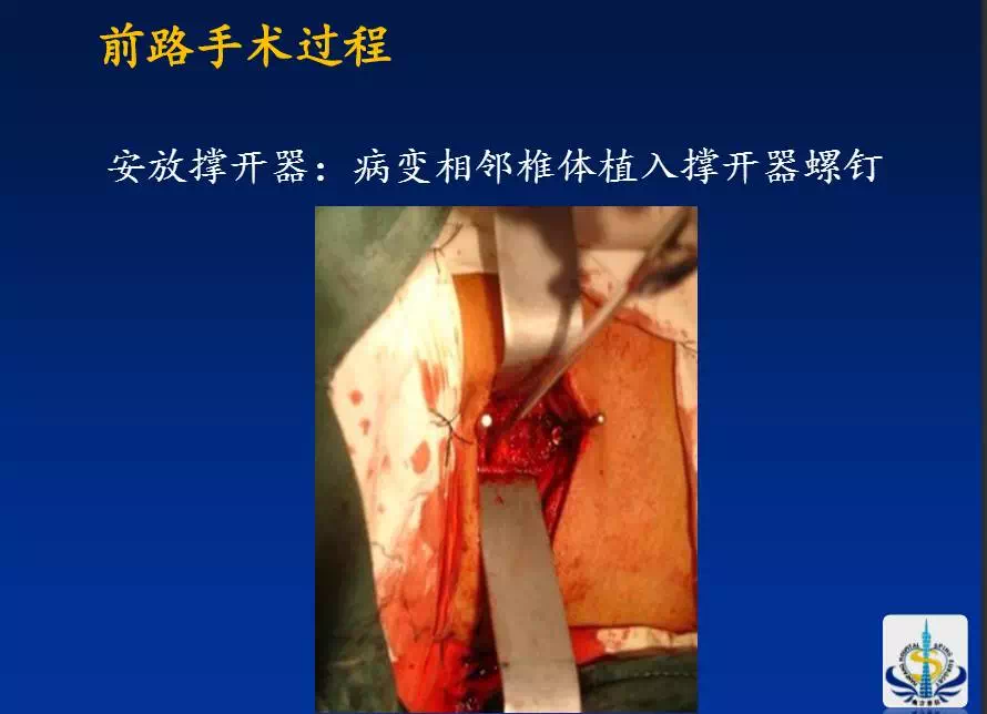 下颈椎骨折手术治疗 - 好大夫在线 ·智慧互联