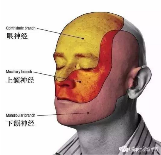 答疑三叉神经痛: 射频热凝治疗的几个疑问