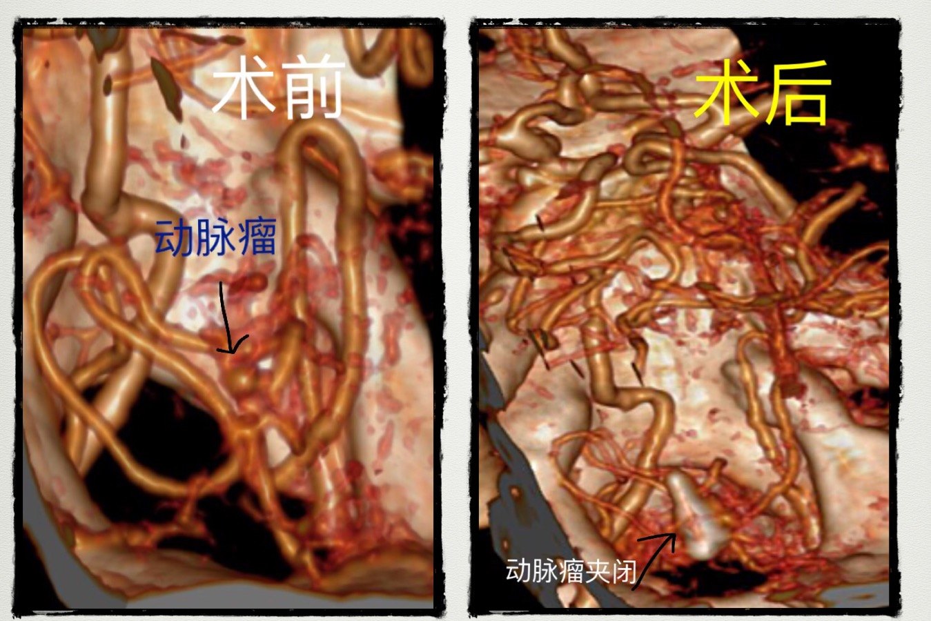 微创锁孔夹闭小脑后下动脉远端动脉瘤窦以河青大附院