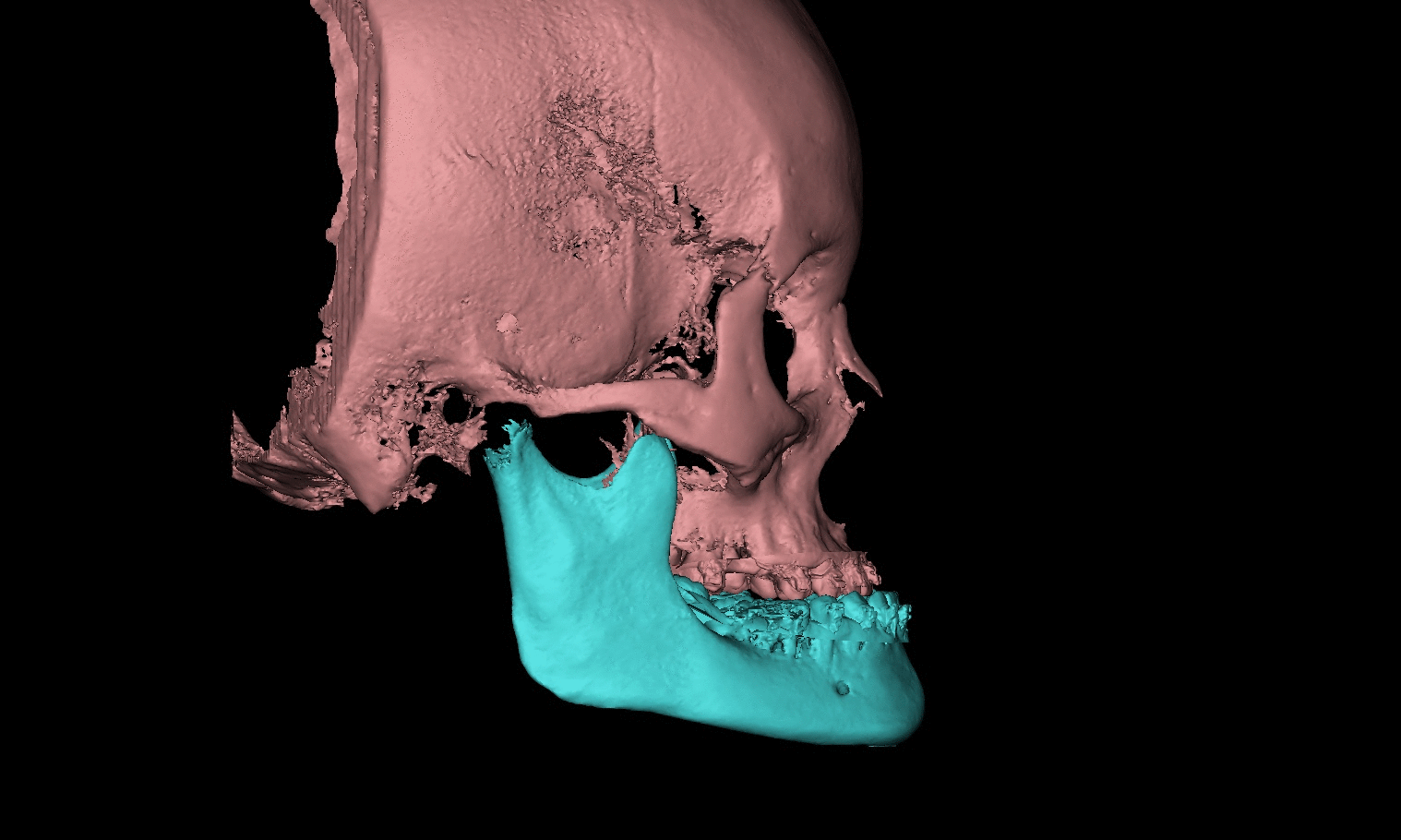 骨性iii类牙颌面畸形地包天的正畸正颌联合治疗