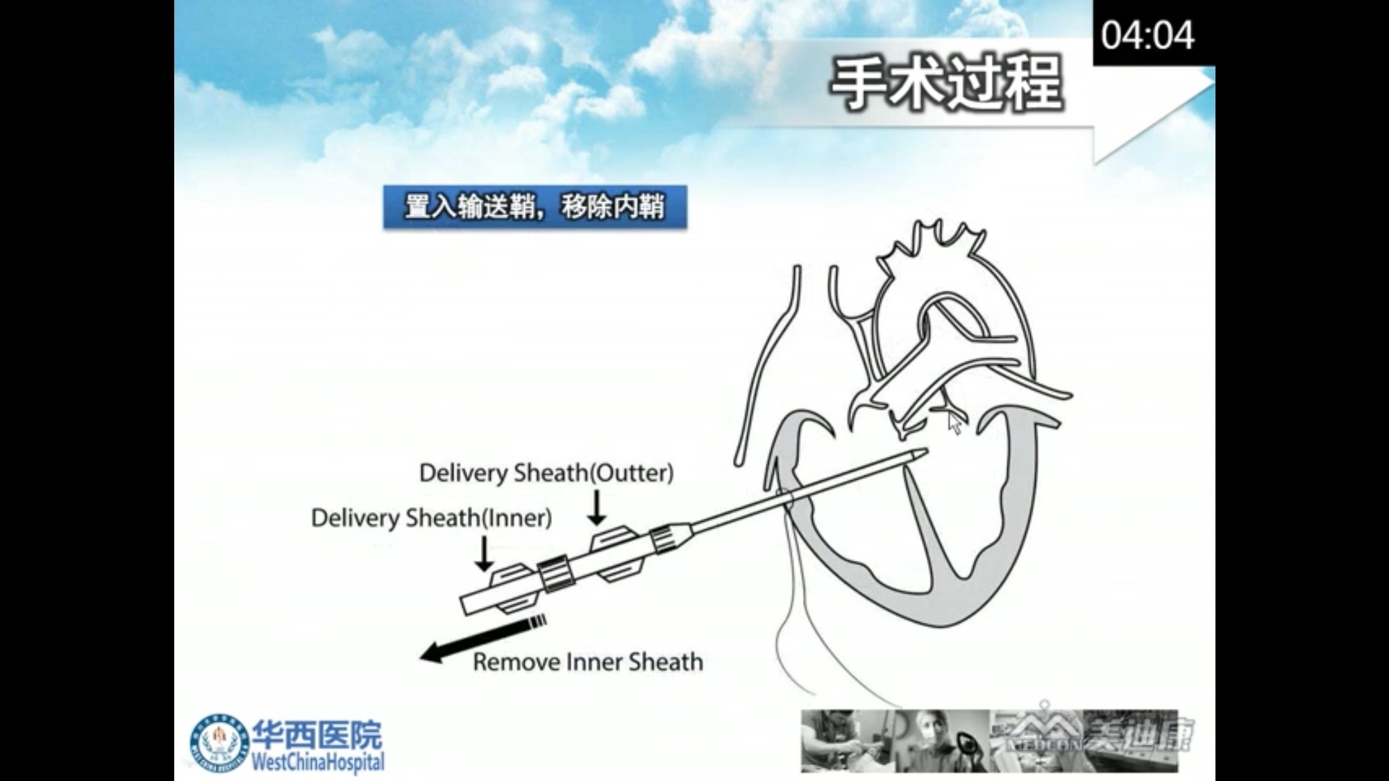 室间隔缺损封堵示意图