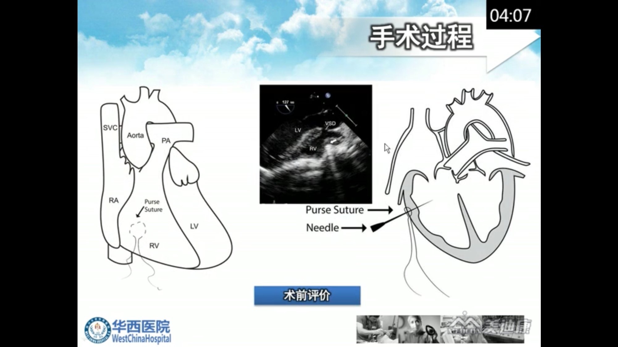 室间隔缺损封堵示意图