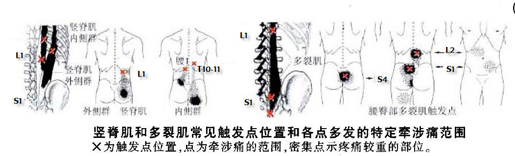 而且痛点处常可触及条索状的结节和肌肉痉挛条索!