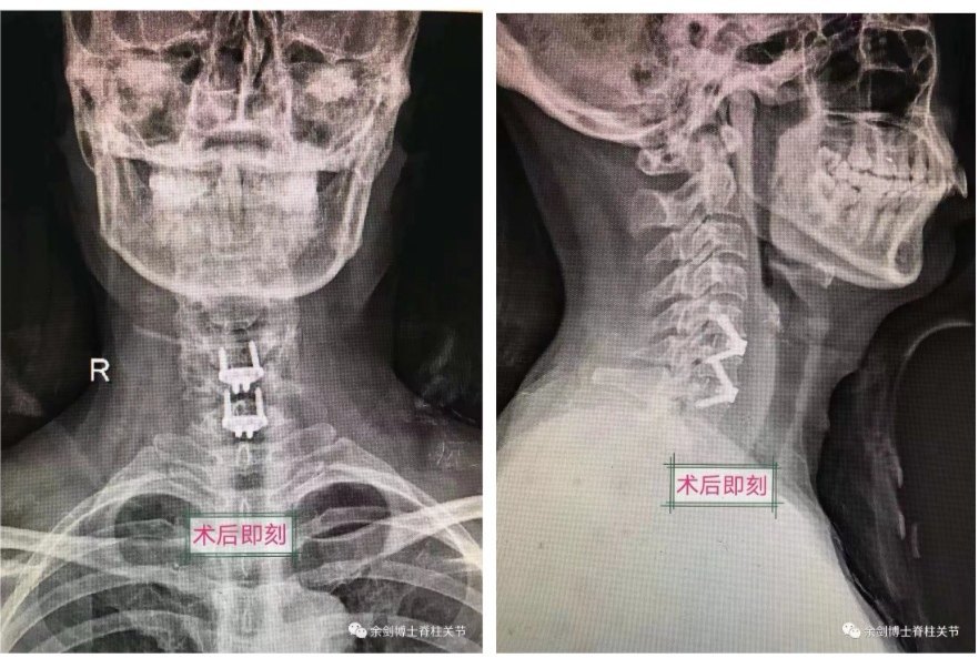 【领先技术】颈椎病的手术治疗(1):颈前路减压 零切迹自稳融合器椎间