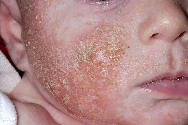 婴幼儿湿疹如何护肤?