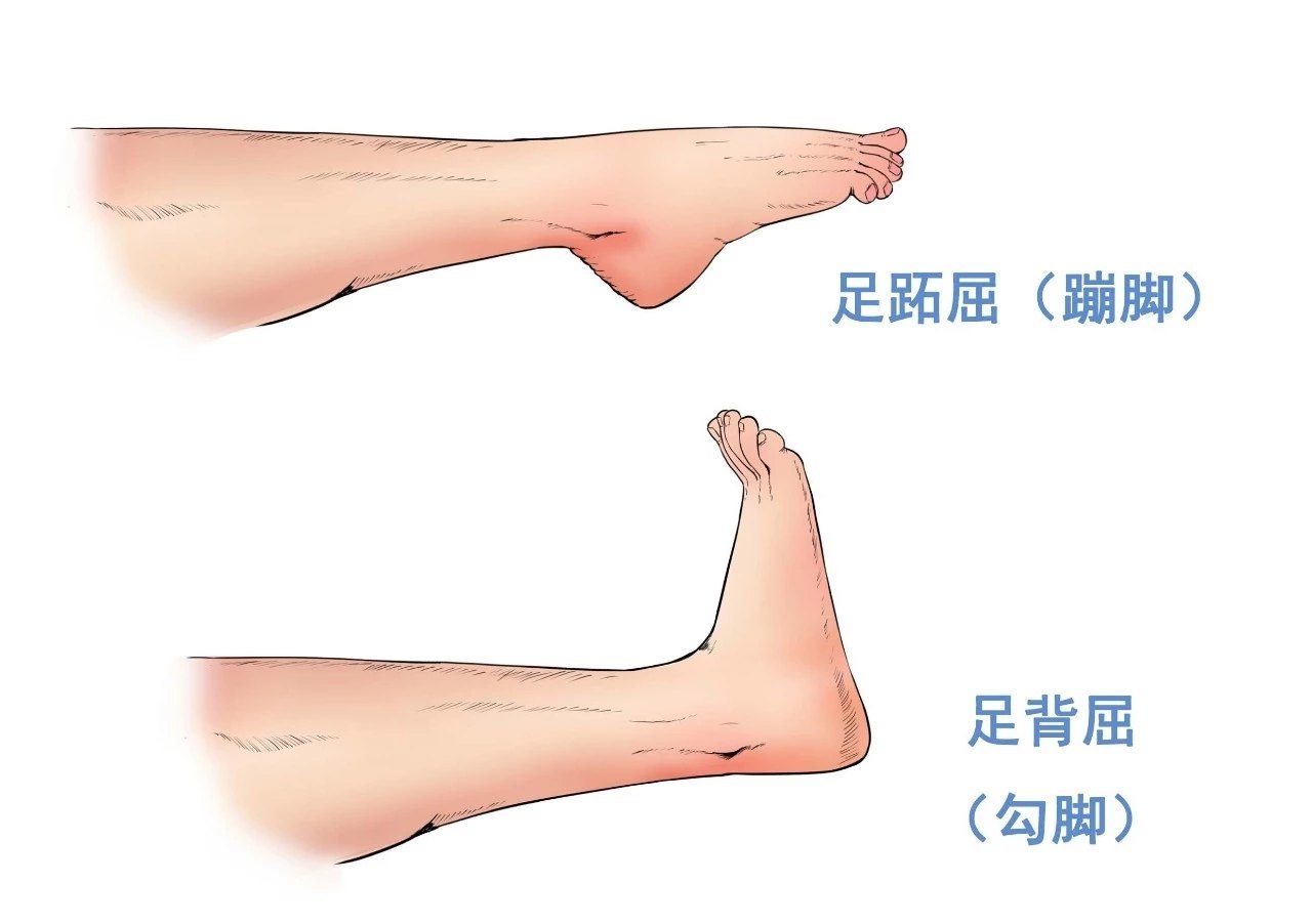 一,踝泵运动:标准方法:术前患肢肌肉虽然没任何机械损伤,但患者因膝部