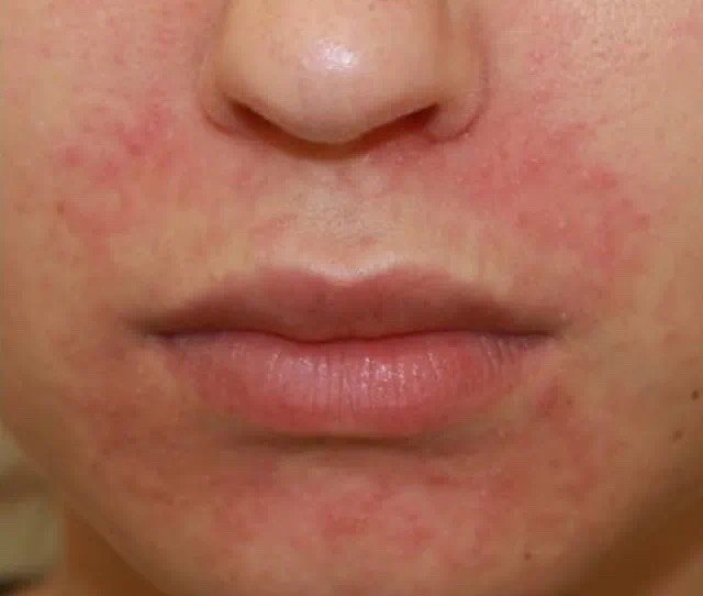 皮损表现为红斑基础上成群的毛囊性丘疹,丘疱疹和丘脓疱疹,表面有脱屑