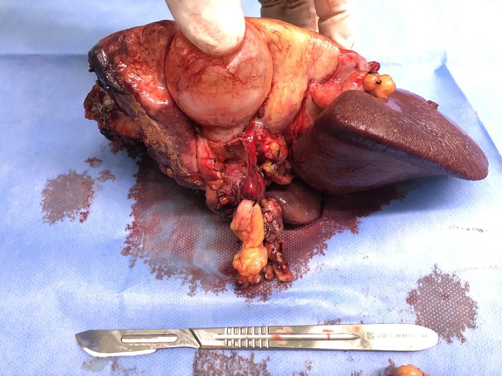 肝左三叶联合全尾叶切除治疗肝门部巨大胆管细胞癌