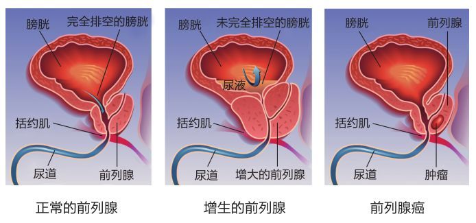 前列腺大就是前列腺增生吗?7个常见误区一次澄清!