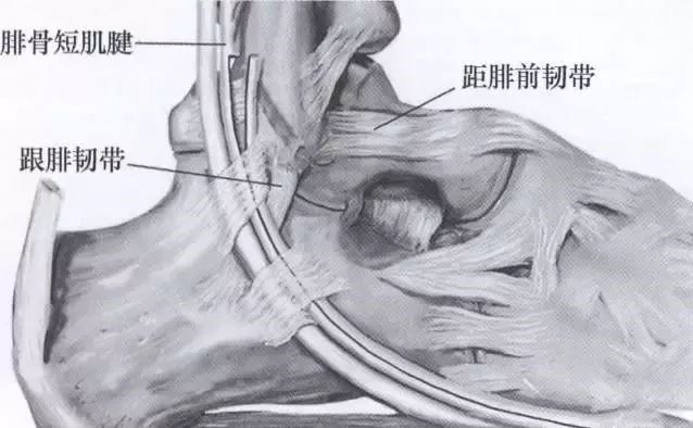 切取腓骨短肌腱的前半部分,保留腓骨肌上支持带.