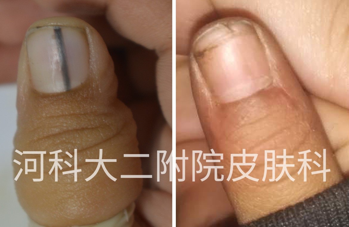 窄的甲母痣,开窗直接切除术后5个月随访情况