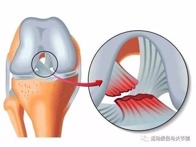 前交叉韧带断裂的那些事