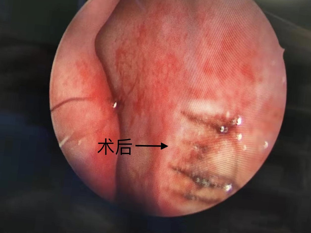 鼻出血内镜下精准止血