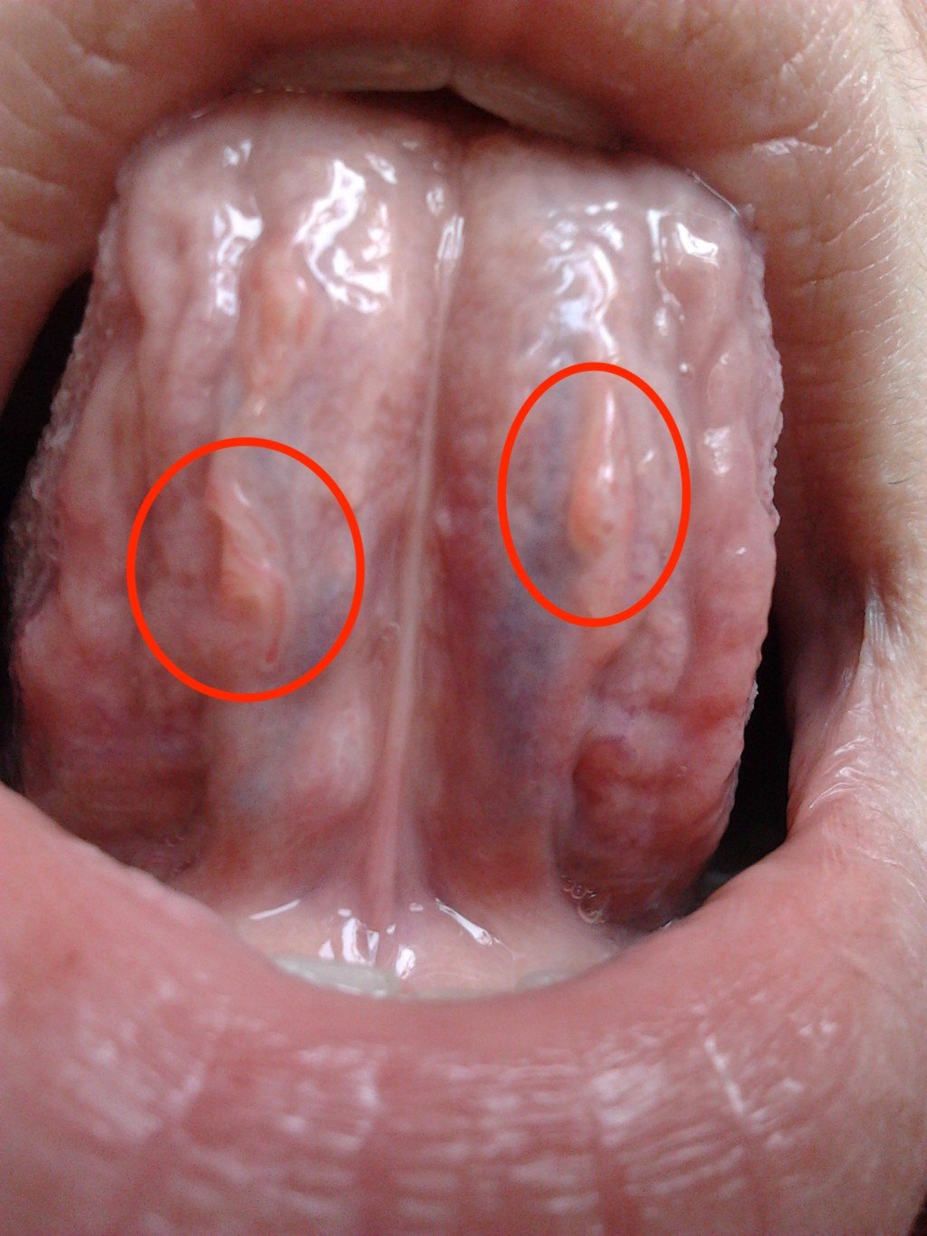 舌下长刺刺到底是不是尖锐湿疣【图片内容可能使您不适,请谨慎点击】