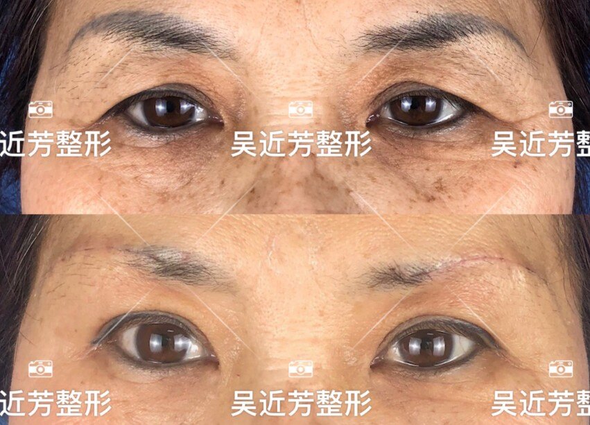 中老年性上睑皮肤松弛