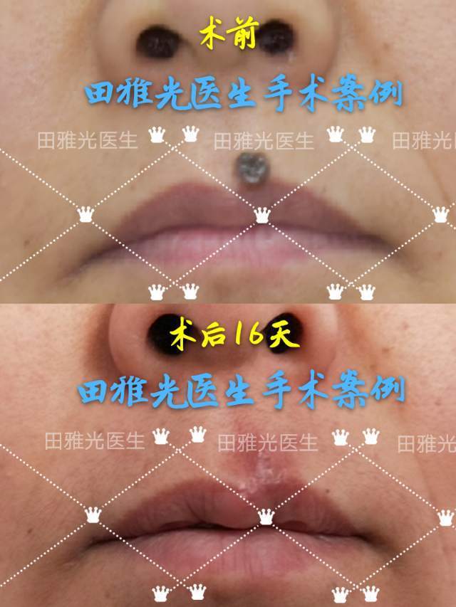 唇部色素痣随诊