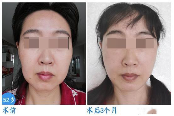 做面部拉皮手术想要效果好头套一定要戴