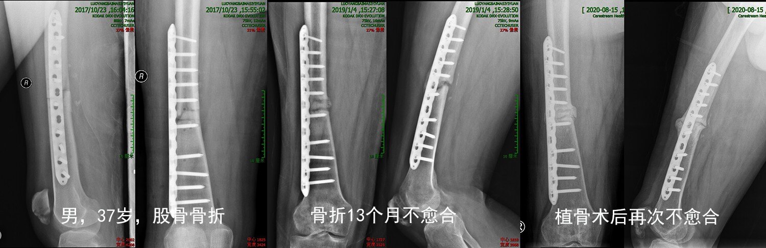 骨折3年不愈合,精准医疗把梦圆