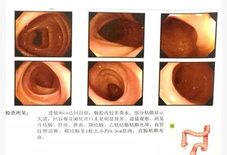 全面了解结肠镜检查前,中,后细节_肠镜 好大夫在线