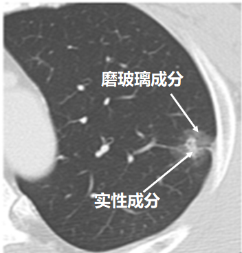 楔形切除?哪些早期肺癌可以少切肺?