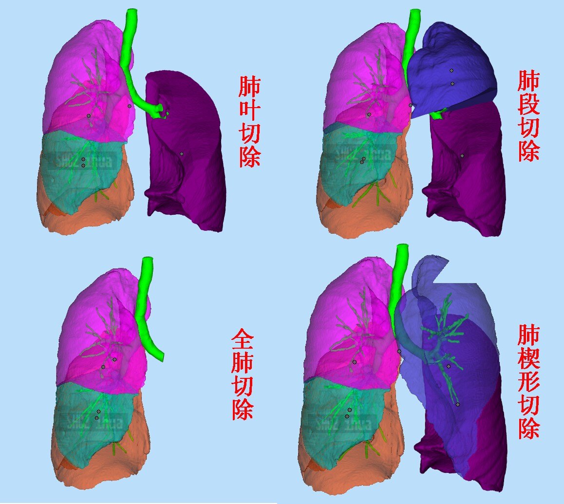 什么是肺切除术浅谈全肺肺叶肺段或楔形切除术