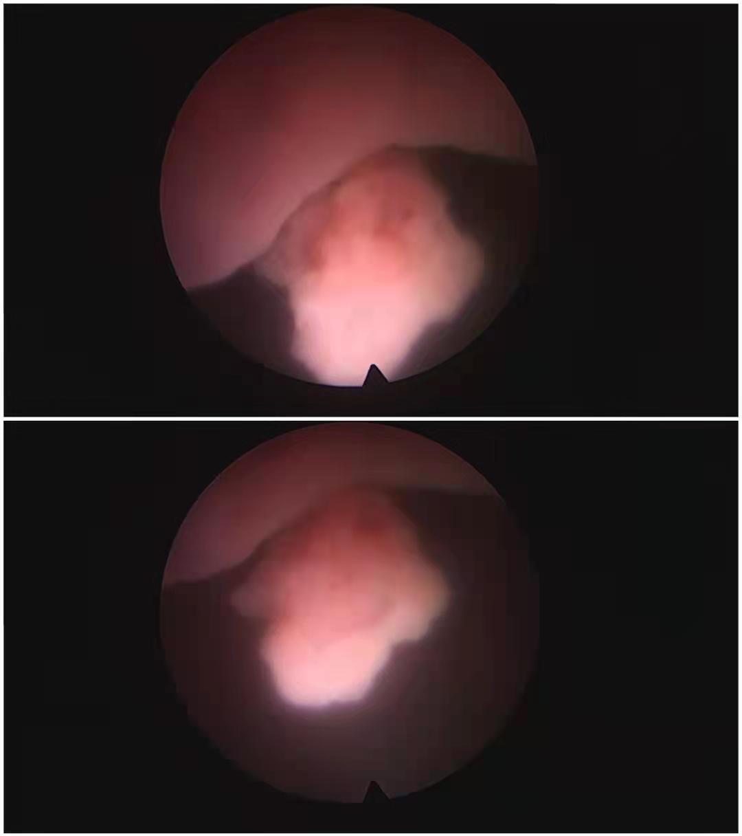 膀胱镜检查到底有啥用附视频