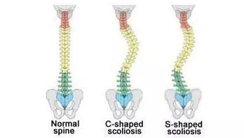 s型脊柱侧弯自己怎么矫正?我来告诉你