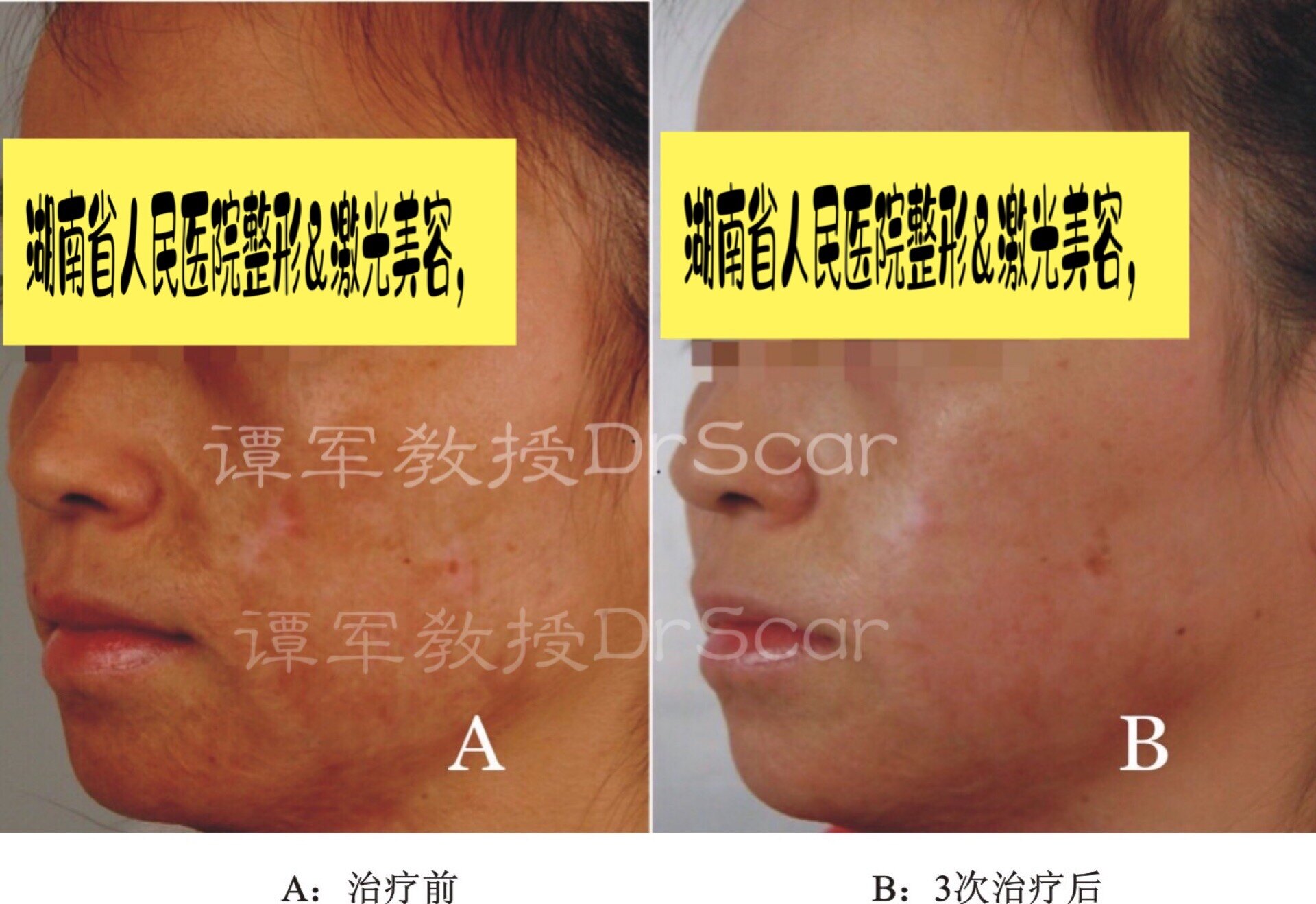 瘢痕色素的激光皮肤再生修复的原理和临床案例