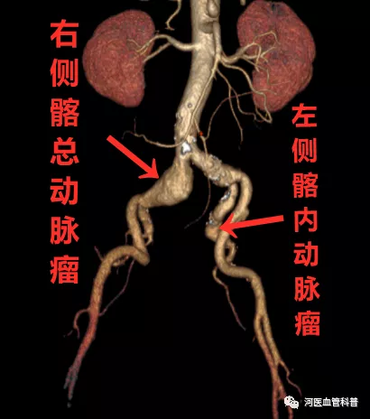 消灭髂动脉瘤完美重建髂内动脉保留盆腔脏器功能